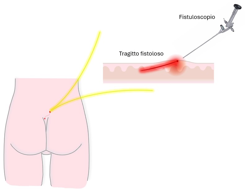EPSIT: Endoscopic Pilonidal Sinus Treatment