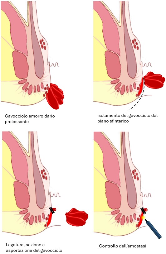 Emorroidectomia: emorroidi