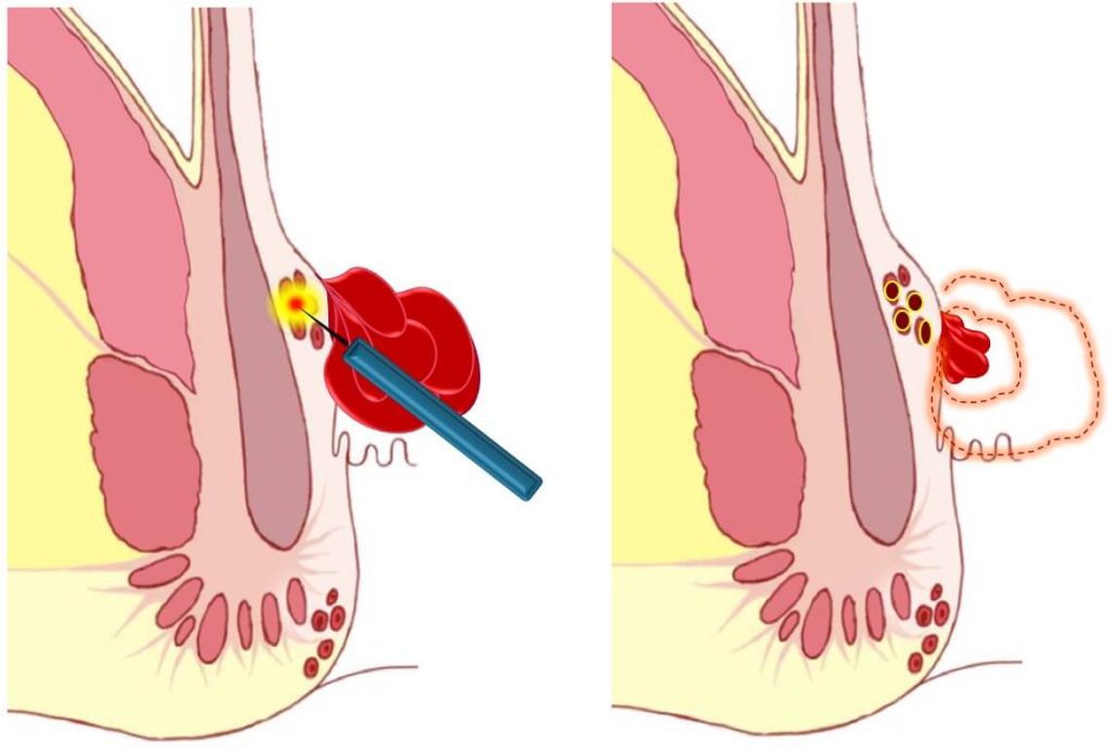 HeLP, Laser per emorroidi