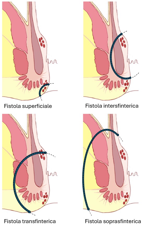 Fistola anale